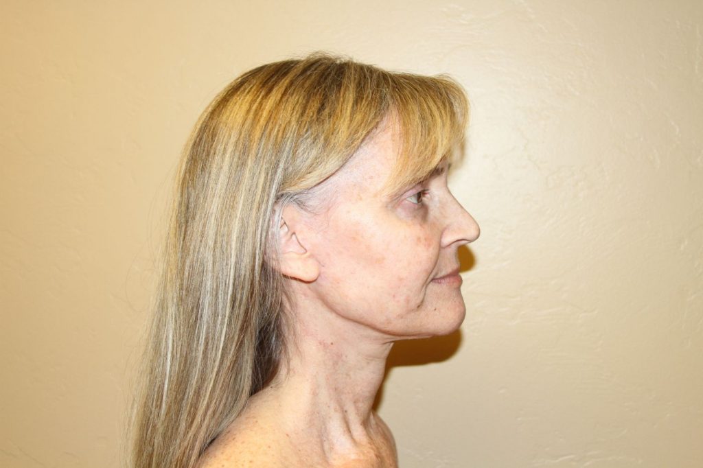 30-facelift-neck-lift-6