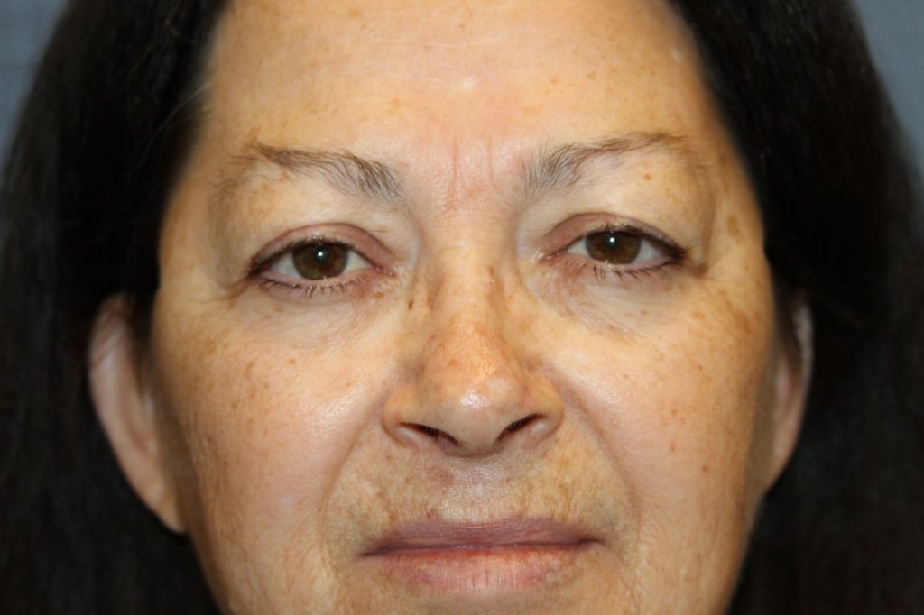 Eyelid Lift