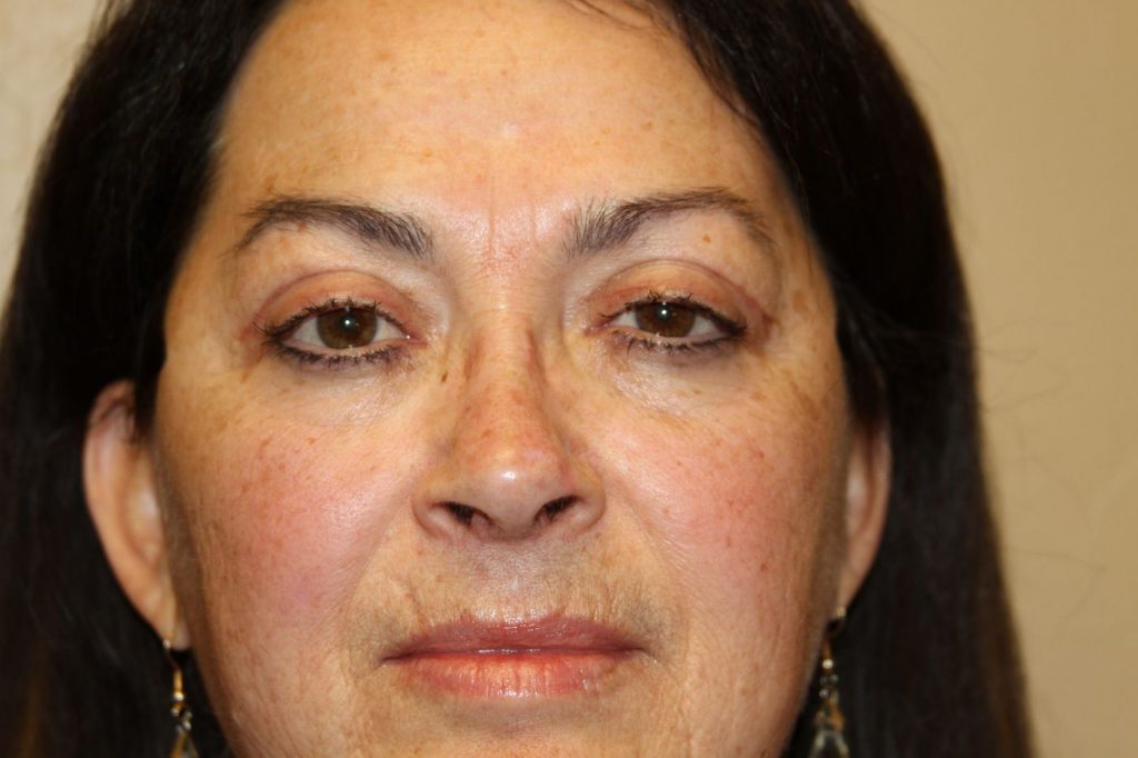 Eyelid Lift