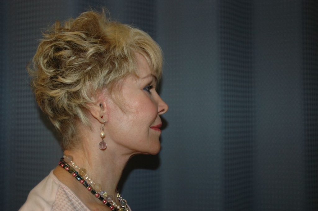 4-facelift-neck-lift-4