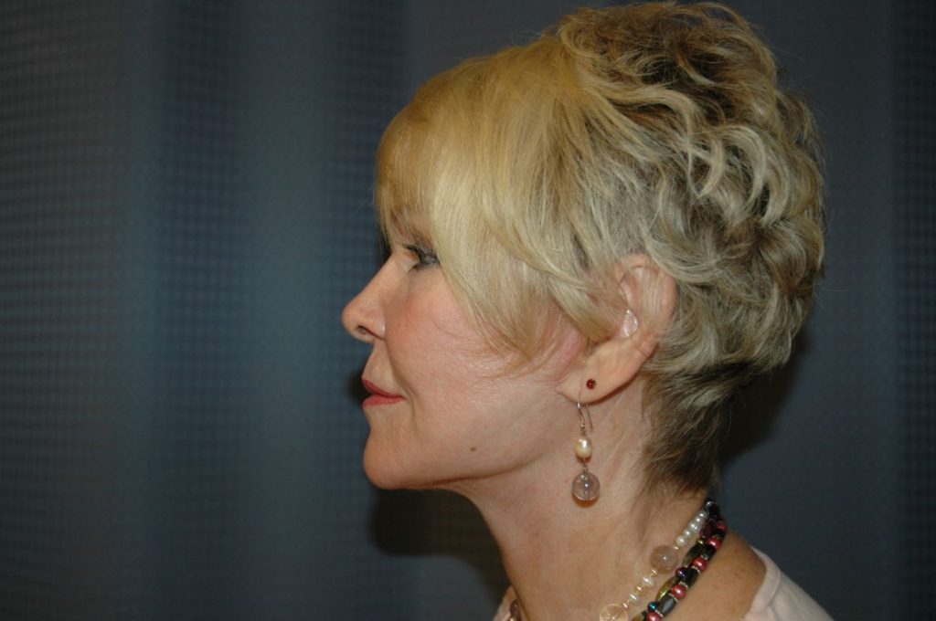 4-facelift-neck-lift-6