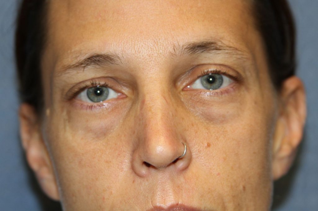 Eyelid Lift