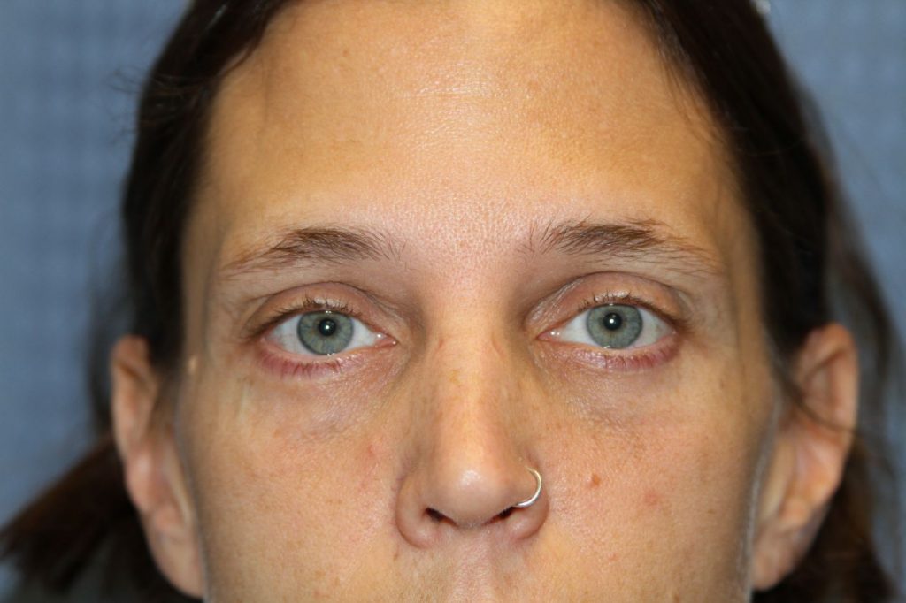 Eyelid Lift
