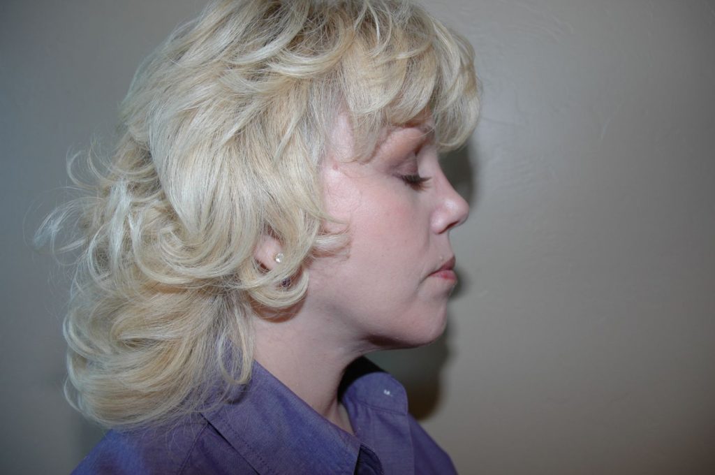 6-facelift-neck-lift-4