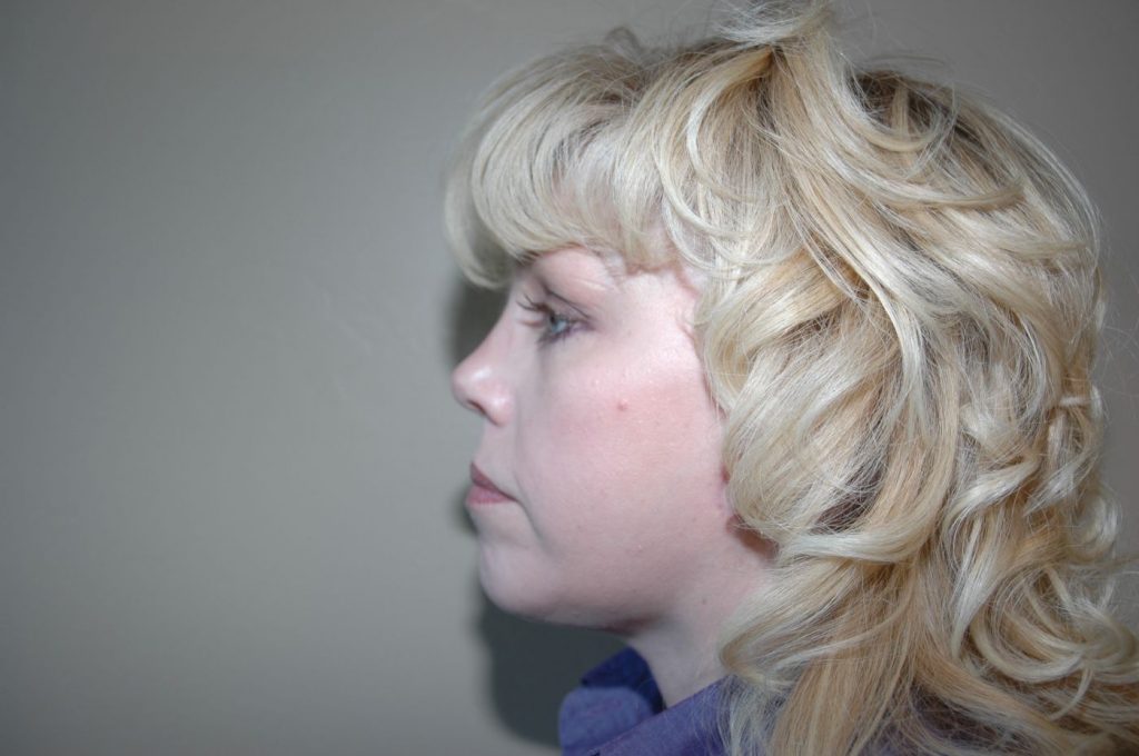 6-facelift-neck-lift-6