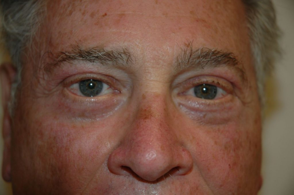 Eyelid Lift