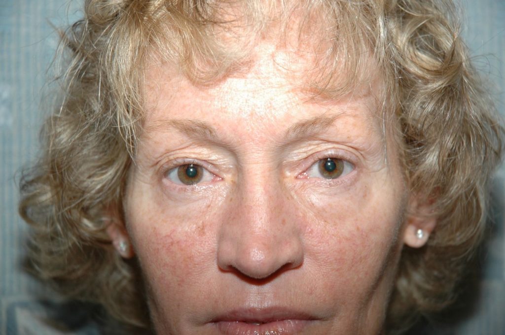Eyelid Lift