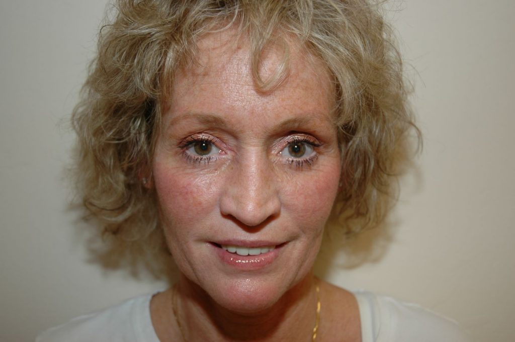 Eyelid Lift