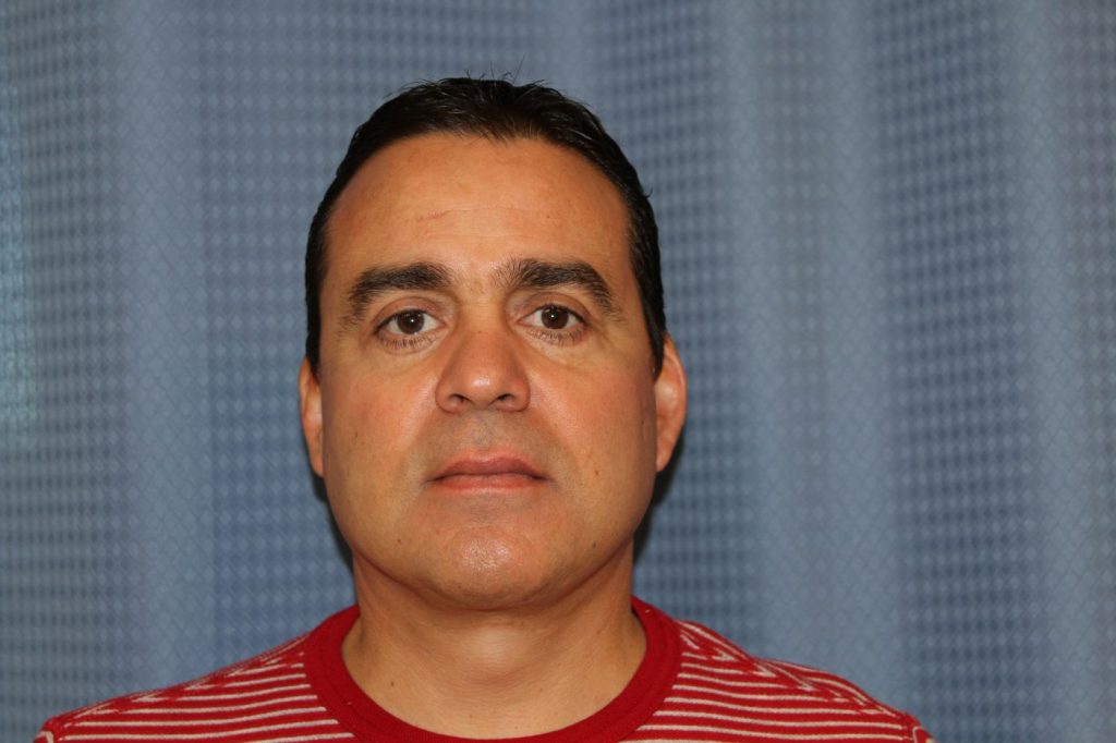 Facelift & Neck Lift