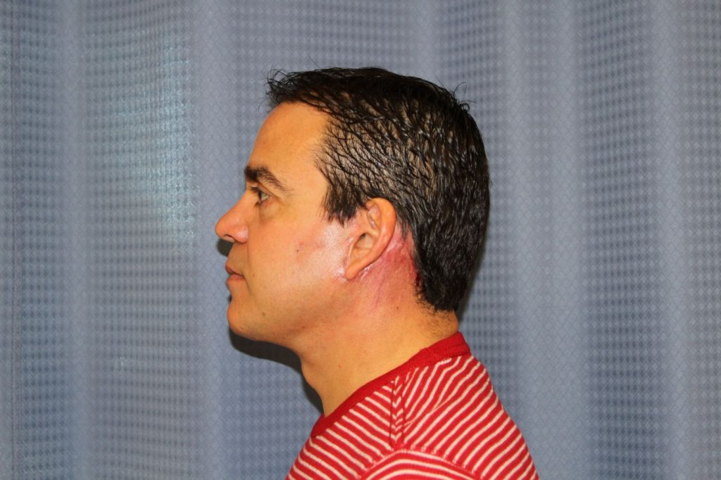8-facelift-neck-lift-4