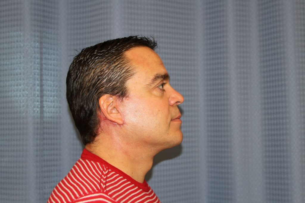 8-facelift-neck-lift-6
