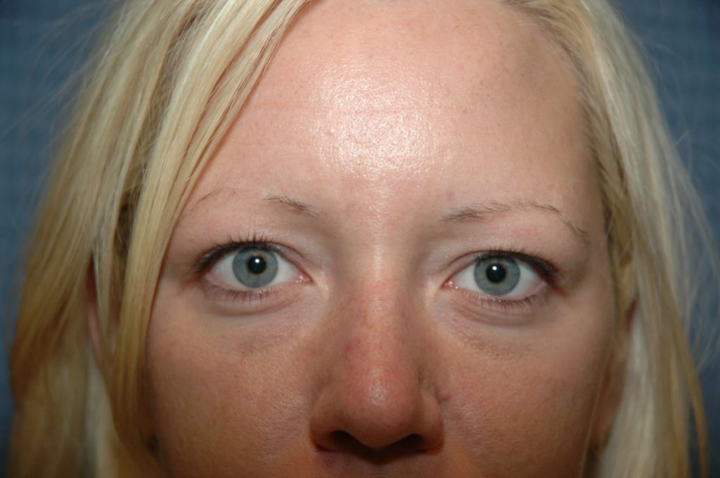 Eyelid Lift