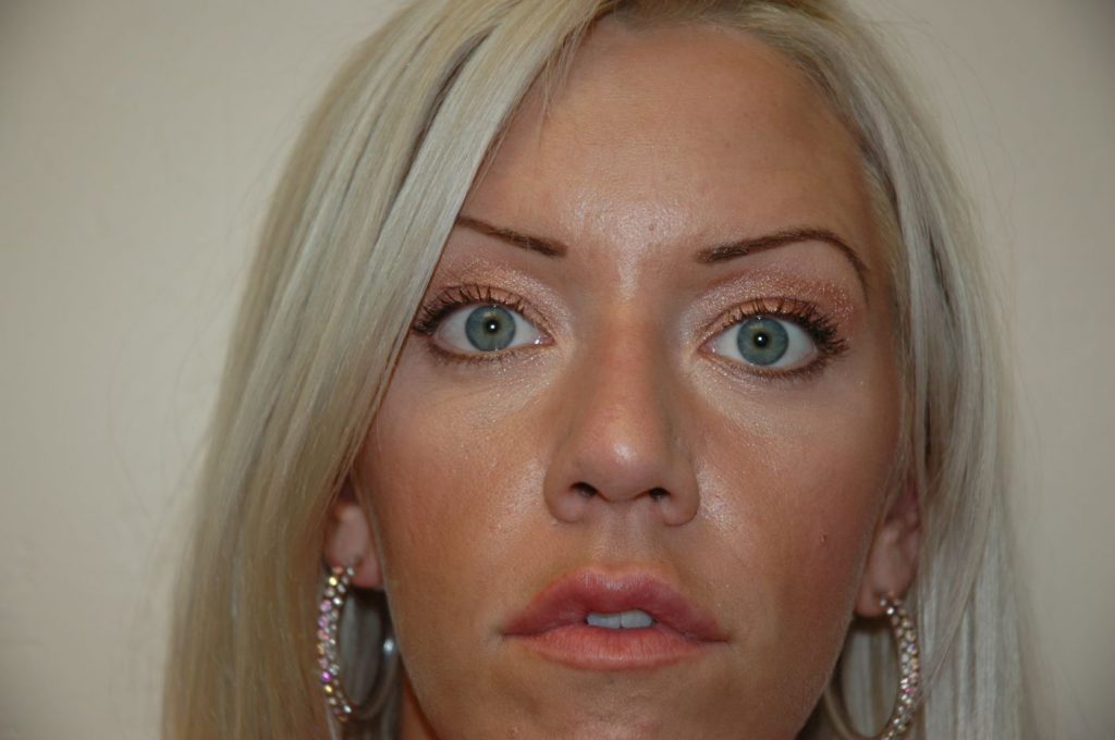 Eyelid Lift