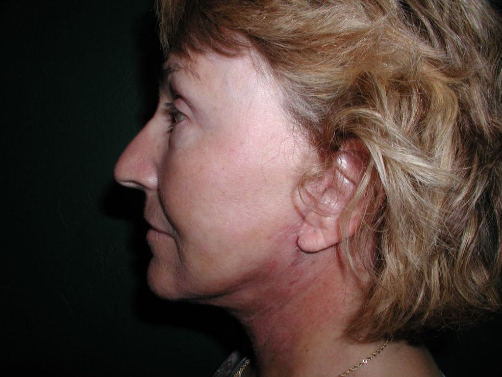 9-facelift-neck-lift-2
