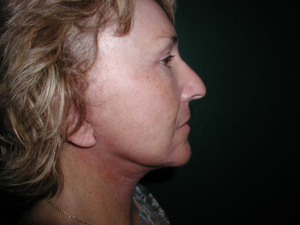 9-facelift-neck-lift-6